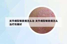 关节病型银屑病怎么治 关节病型银屑病怎么治疗效果好