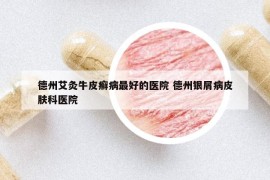 德州艾灸牛皮癣病最好的医院 德州银屑病皮肤科医院