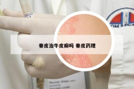 秦皮治牛皮癣吗 秦皮药理