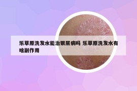 乐草原洗发水能治银屑病吗 乐草原洗发水有啥副作用