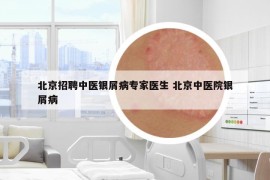 北京招聘中医银屑病专家医生 北京中医院银屑病