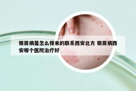 银屑病是怎么得来的联系西安北方 银屑病西安哪个医院治疗好