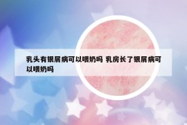 乳头有银屑病可以喂奶吗 乳房长了银屑病可以喂奶吗