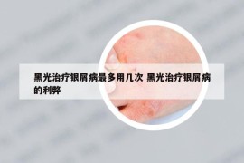 黑光治疗银屑病最多用几次 黑光治疗银屑病的利弊