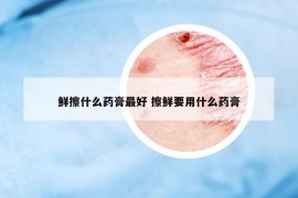 鲜擦什么药膏最好 擦鲜要用什么药膏