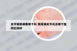 关节银屑病看哪个科 银屑病关节炎去哪个医院比较好