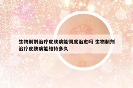 生物制剂治疗皮肤病能彻底治愈吗 生物制剂治疗皮肤病能维持多久