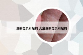 皮癣怎么引起的 儿童皮癣怎么引起的