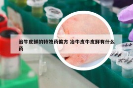 治牛皮鲜的特效药偏方 冶牛皮牛皮鲜有什么药