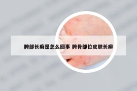 胯部长癣是怎么回事 胯骨部位皮肤长癣