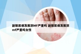 副银屑病发展到MF严重吗 副银屑病发展到mf严重吗女性