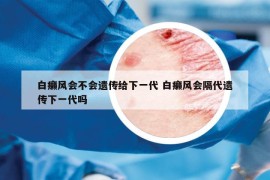 白癞风会不会遗传给下一代 白癞风会隔代遗传下一代吗