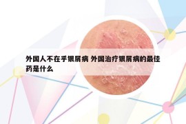 外国人不在乎银屑病 外国治疗银屑病的最佳药是什么