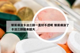 银屑病涂卡泊三醇一直好不透呢 银屑病涂了卡泊三醇越来越大