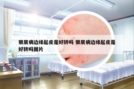 银屑病边缘起皮是好转吗 银屑病边缘起皮是好转吗图片
