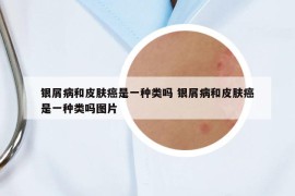 银屑病和皮肤癌是一种类吗 银屑病和皮肤癌是一种类吗图片