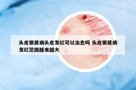 头皮银屑病头皮发红可以治愈吗 头皮银屑病发红范围越来越大