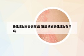 维生素b软膏银屑病 银屑病吃维生素b有用吗