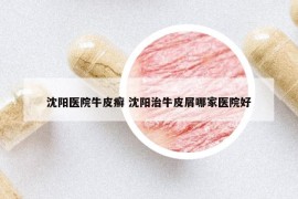 沈阳医院牛皮癣 沈阳治牛皮屑哪家医院好