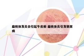 扁桃体发炎会引起牛皮癣 扁桃体炎引发银屑病