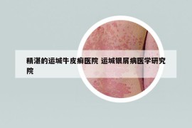 精湛的运城牛皮癣医院 运城银屑病医学研究院