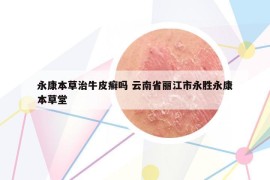 永康本草治牛皮癣吗 云南省丽江市永胜永康本草堂