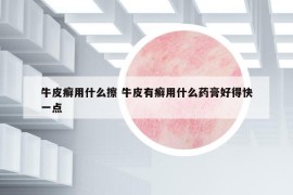 牛皮癣用什么擦 牛皮有癣用什么药膏好得快一点