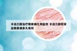 卡泊三醇治疗银屑病几周起效 卡泊三醇软膏治银屑病多久有效