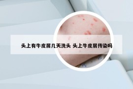 头上有牛皮屑几天洗头 头上牛皮屑传染吗