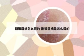 副银屑病怎么得的 副银屑病是怎么得的