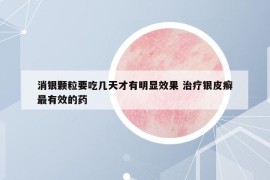 消银颗粒要吃几天才有明显效果 治疗银皮癣最有效的药