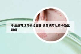 牛皮癣可以用卡泊三醇 银屑病可以用卡泊三醇吗