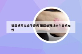 银屑病可以吃牛膏吗 银屑病可以吃牛膏吗女性