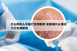 什么样的人不能打生物制剂 皮肤病什么情况下打生物制剂