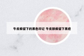 牛皮癣留下的黑色印记 牛皮肤癣留下黑疤