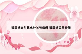银屑病会引起水肿关节痛吗 银屑病关节肿胀