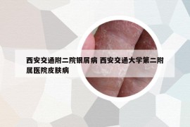 西安交通附二院银屑病 西安交通大学第二附属医院皮肤病