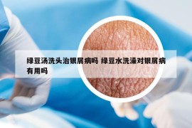 绿豆汤洗头治银屑病吗 绿豆水洗澡对银屑病有用吗