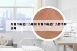 后背长癣是什么原因 后背长癣是什么样子的图片