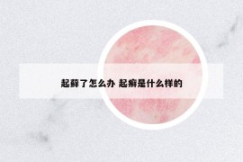 起藓了怎么办 起癣是什么样的