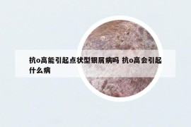 抗o高能引起点状型银屑病吗 抗o高会引起什么病