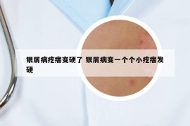 银屑病疙瘩变硬了 银屑病变一个个小疙瘩发硬