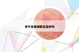 有牛皮癣病勤洗澡好吗