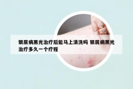 银屑病黑光治疗后能马上清洗吗 银屑病黑光治疗多久一个疗程