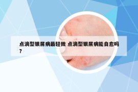 点滴型银屑病最轻微 点滴型银屑病能自愈吗?