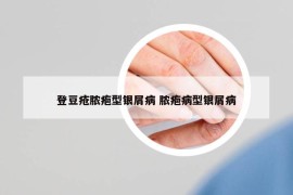 登豆疮脓疱型银屑病 脓疱病型银屑病