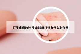 打牛皮癣的针 牛皮肤癣打针有什么副作用