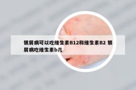 银屑病可以吃维生素B12和维生素B2 银屑病吃维生素b几