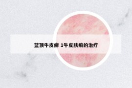 蓝顶牛皮癣 1牛皮肤癣的治疗