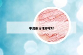 牛皮癣治理哪家好